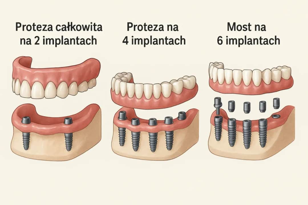 Ile kosztuje sklejenie protezy zębowej? Sprawdź ceny napraw i oszczędności