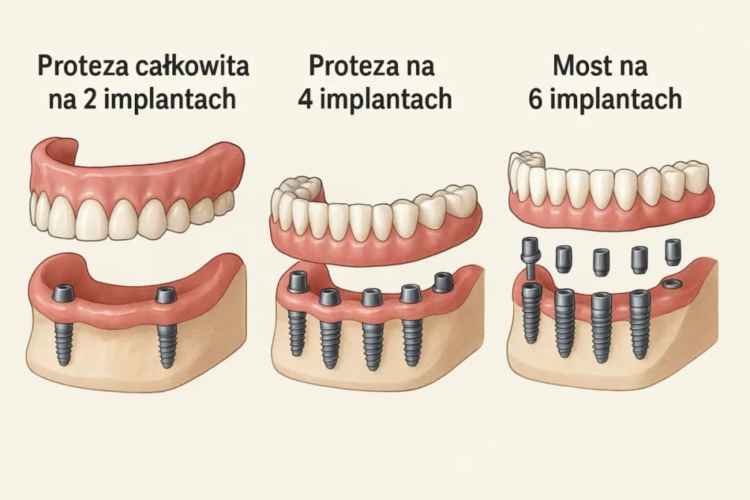 Ile kosztuje sklejenie protezy zębowej? Sprawdź ceny napraw i oszczędności